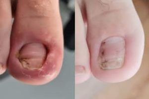 Ingrown Toenails Before | After