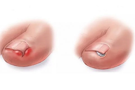 Ingrown Toenails