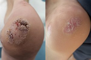  Plantar Warts Before | After