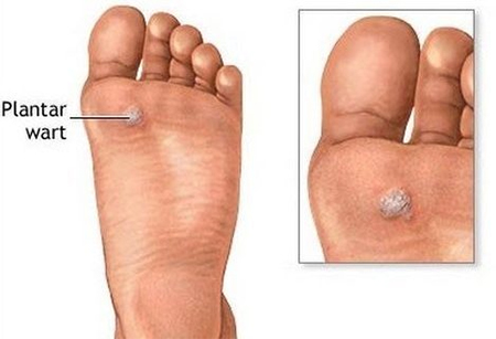 Plantar Warts